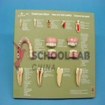 Dental Disease: Mounted Model